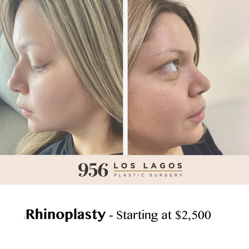 Before and After Result